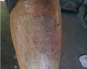 河南牛皮癬醫院怎樣選擇