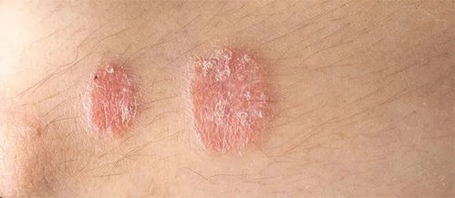 深圳膚康皮膚病專科 牛皮癬治療原則及注意事項