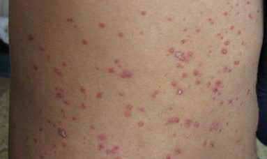 銀屑病(牛皮癬)對身體的危害