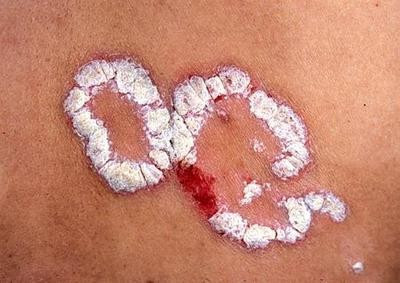 牛皮癬牛皮癬-什么是牛皮癬及圖片