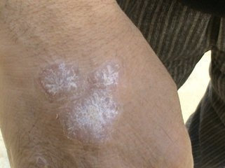 銀屑病治療后的圖片