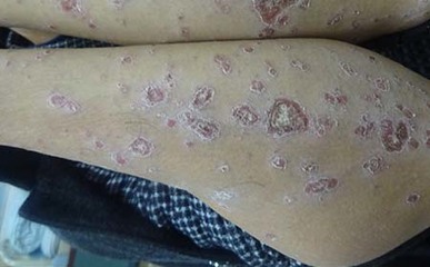 引發牛皮癬出現的因素是什么