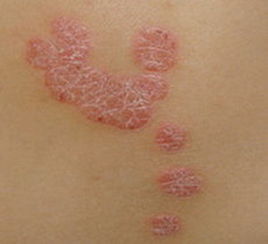 治療牛皮癬吃什么東西比較好