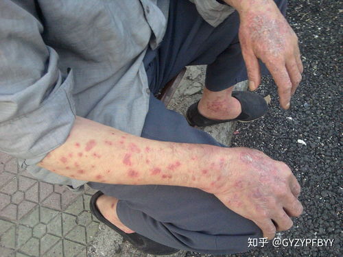 牛皮癬怎么護理,貴陽看牛皮癬的醫院在哪里