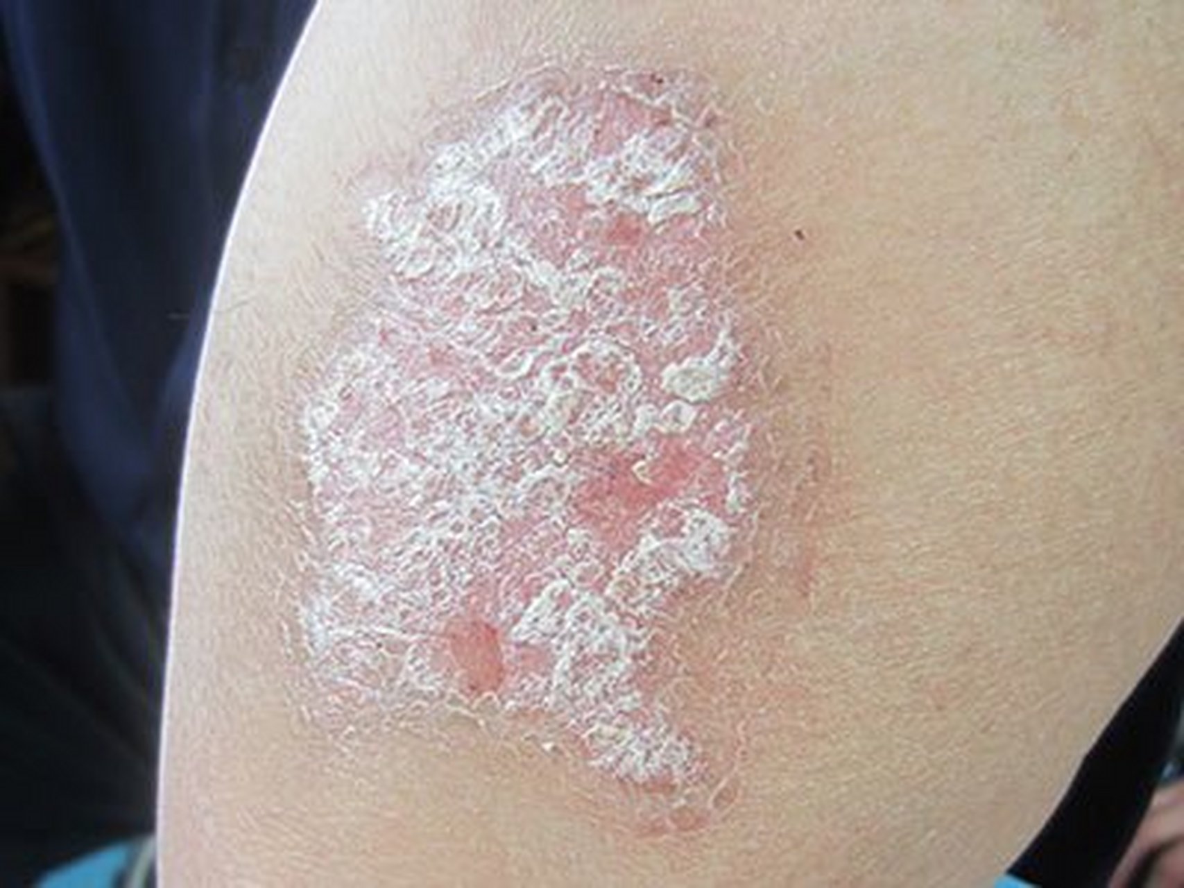 #皮膚病##頭部銀屑病# #牛皮癬# 銀屑病傳染嗎? 銀屑病可以發生在臉