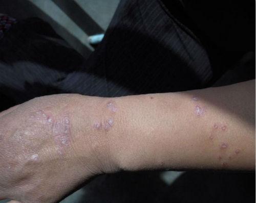 牛皮癬3種常用的藥膏,用了不易復發,一人收藏,全家人不生癬