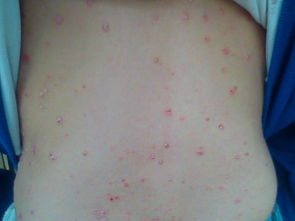 牛皮癬吃什么好一點呢