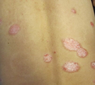 中年膿皰型牛皮癬手術治療