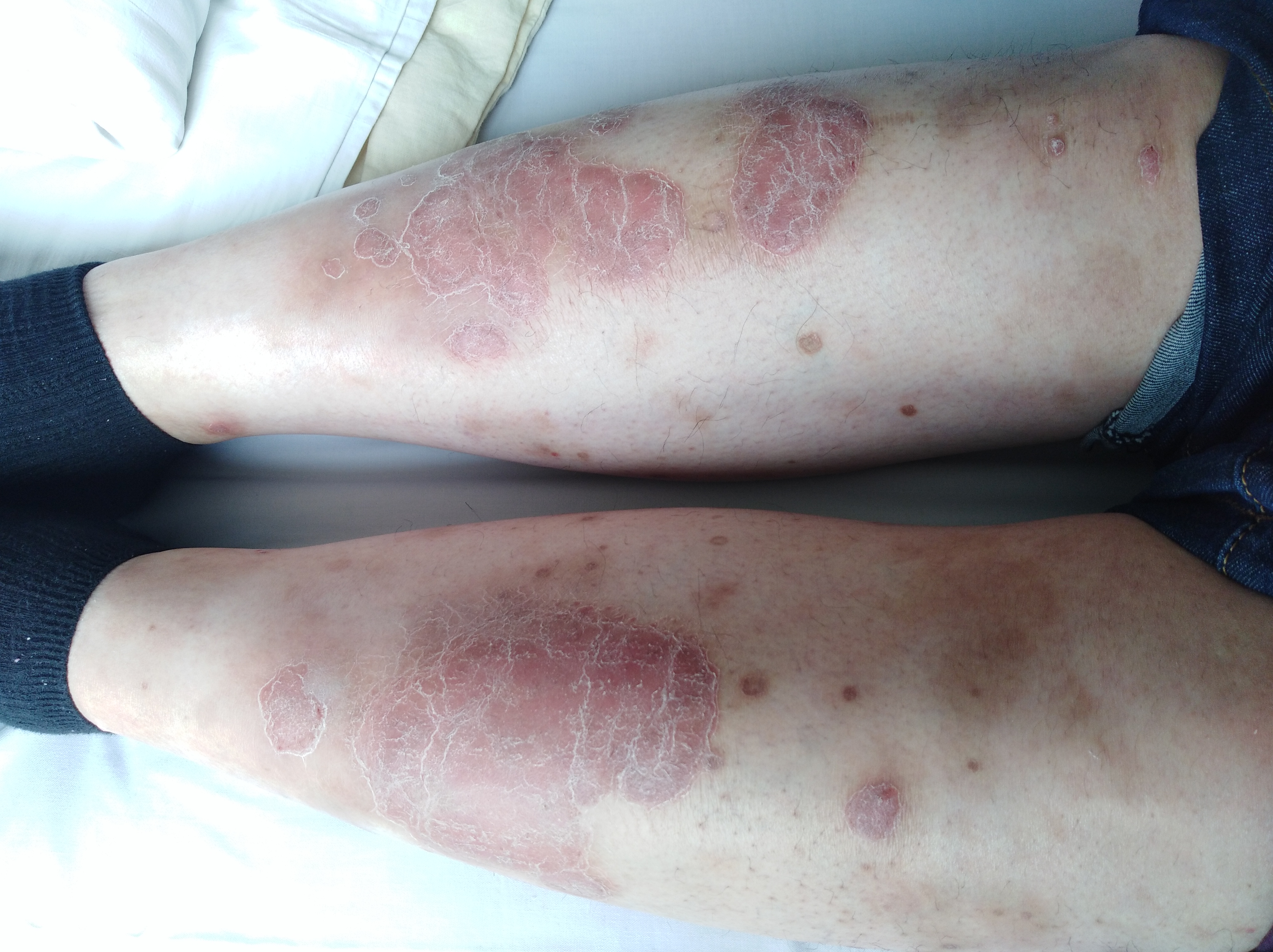 銀屑病「牛皮癬」是真菌感染所致的「癬病」嗎?-毛夢平執業醫師-愛問