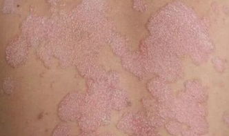 牛皮癬 銀屑病 患者注意,正確辨識,才能 過關(guān)斬將