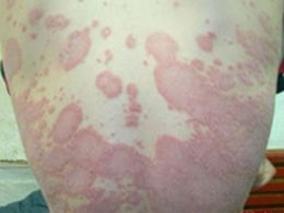 預(yù)防牛皮癬的四步攻略都有哪些