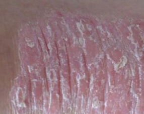 女性關(guān)節(jié)病型牛皮癬西醫(yī)診斷