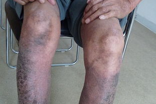 兒童關(guān)節(jié)病型銀屑病診斷