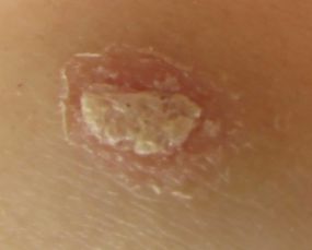 如何選擇治牛皮癬的醫(yī)院