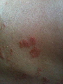 請專業(yè)皮膚人士幫我判定下我的皮膚到底是不是得了牛皮癬還是其他癬