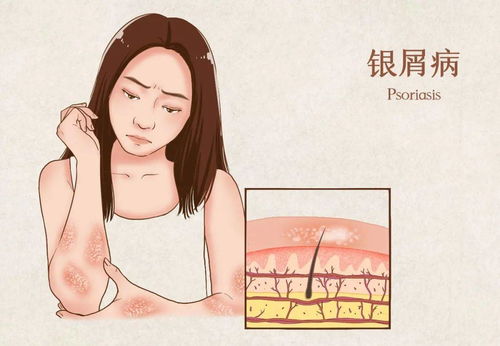 飲食清淡 全吃素 銀屑病患者到底該如何飲食