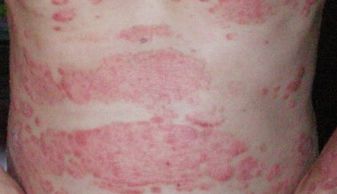 中年紅皮病型牛皮癬壽命