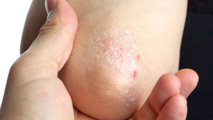 牛皮癬和銀屑病是一樣的嗎?同一疾病