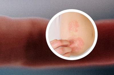 銀屑病哺乳會(huì)傳染嗎