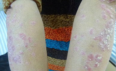 患者脫離牛皮癬 要這樣做啊