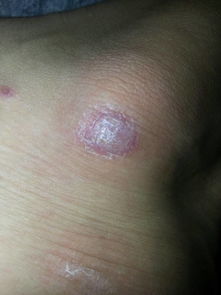 請(qǐng)問這是牛皮癬嘛