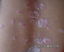 哪些因素會導致銀宵病