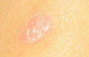 季節性牛皮癬復發前一般都會出現哪些癥狀表現呢