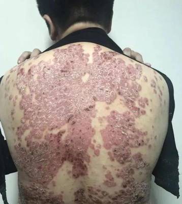 【科普】&ldquo;頑疾&rdquo;銀屑病會傳染嗎?如何治療?市一醫院皮膚科專家帶你走進治療新時代