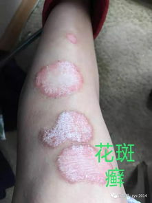 皮膚頑疾為什么好的那么快,原來秘密在這