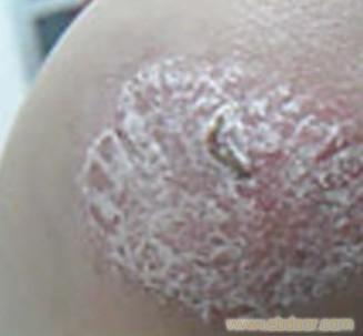 唐山牛皮癬就醫需要注意的四項原則_唐山牛皮癬就醫需要注意的四項原則高清大圖_唐山牛皮癬就醫需要注意的四項原則高清圖片_一比多產品庫