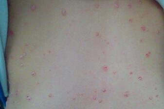 紅皮型牛皮癬初期會有哪些具體表現