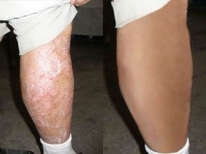 皮膚癢,還反復 牛皮癬 銀屑病 你還想忍多久