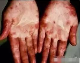 食用菌產品的神奇見證 白癲風 牛皮癬 紅斑狼瘡