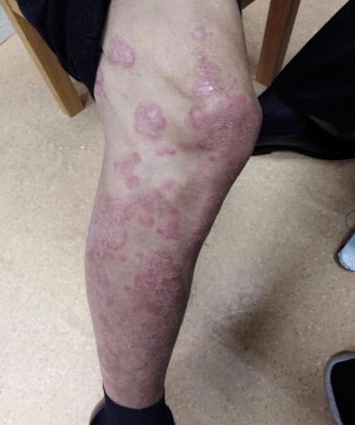 銀屑病患者福音 新型靶向治療藥物 生物制劑