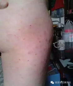 牛皮癬的克星 講述一位嚴重牛皮癬康復過程