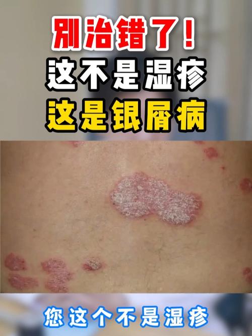 別治錯了!這不是濕疹 這是銀屑病