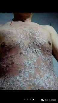 越來越多的牛皮癬患者重獲健康,您為什么不能試一試呢