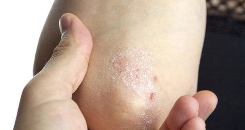 幾塊錢一瓶的甲硝唑,或能幫助擺平這4種病,你了解嗎