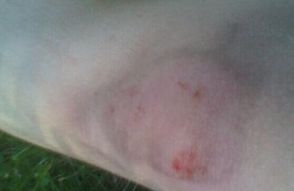 沈陽牛皮癬醫(yī)院該如何選擇