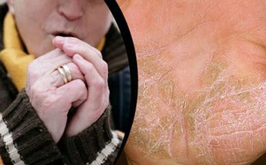 十大銀屑病發(fā)病原因|引起銀屑病誘因和治療方法