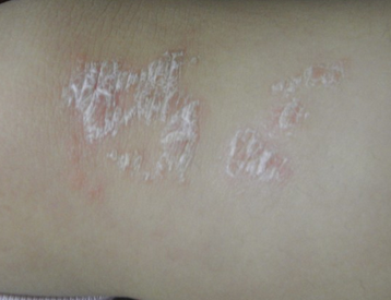 醋泡大蒜能治牛皮癬嗎？科學解讀與理性建議