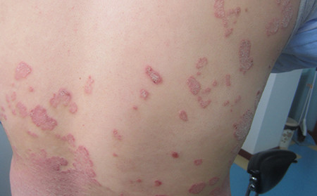 銀屑病早期癥狀識別與預(yù)防