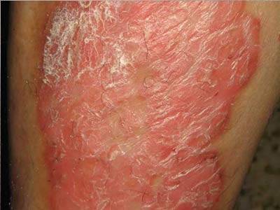 銀屑?。ㄅＦぐ_）的常見癥狀