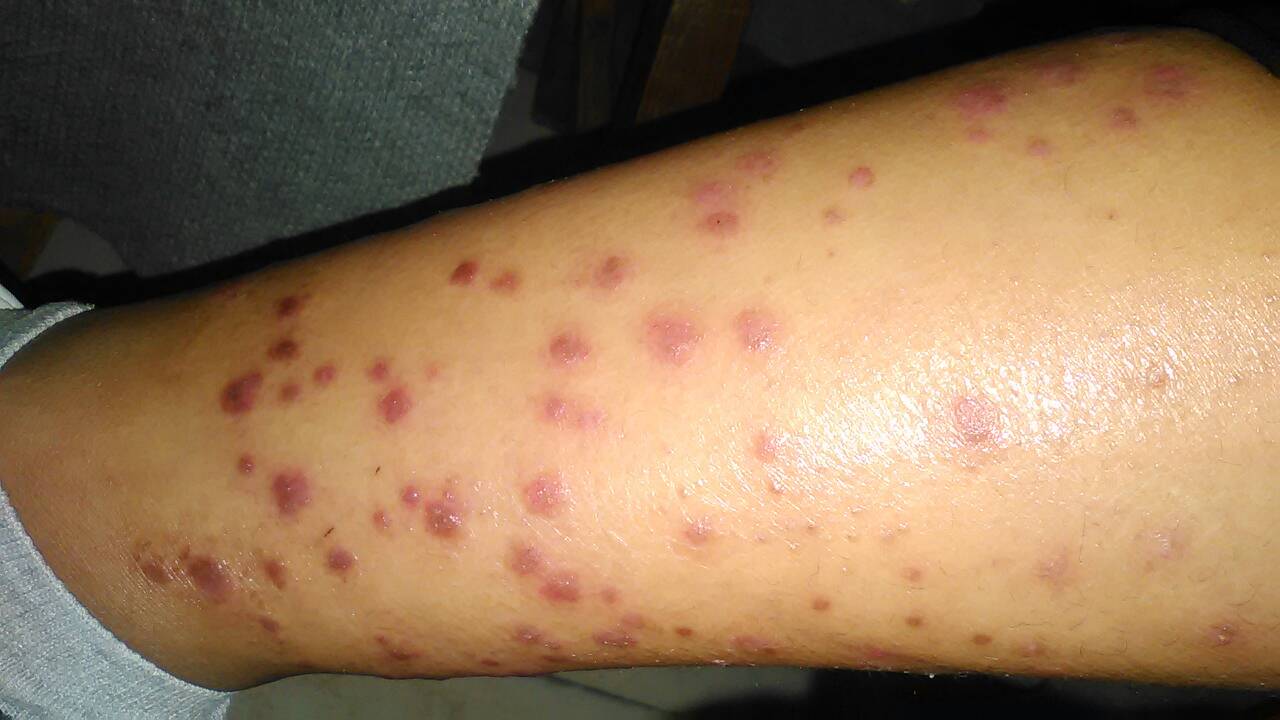 銀屑?。ㄅＦぐ_）的綜合治療與穴位按摩輔助療法