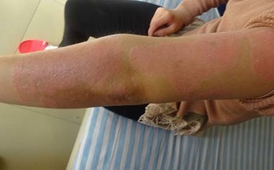 情緒傷害對牛皮癬的影響 潛移默化的身心關聯