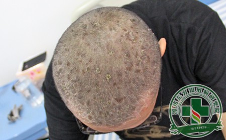 銀屑病甲的悲催過程