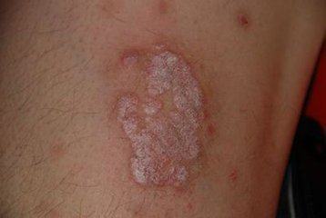 老偏方治療牛皮癬（銀屑?。?傳統智慧的探索與考量