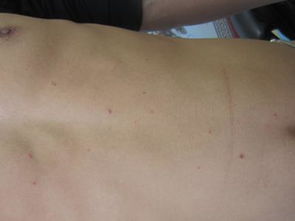 長春中吉皮膚病醫院 牛皮癬專業治療與康復指南