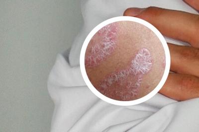 牛皮癬廣告模板 專業治療，重獲健康肌膚