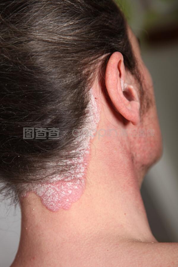 嚴重牛皮癬對頸部與耳內的影響及應對措施